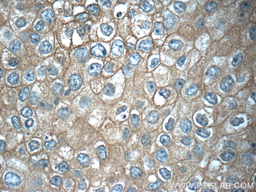 IHC staining of human breast cancer using 25489-1-AP