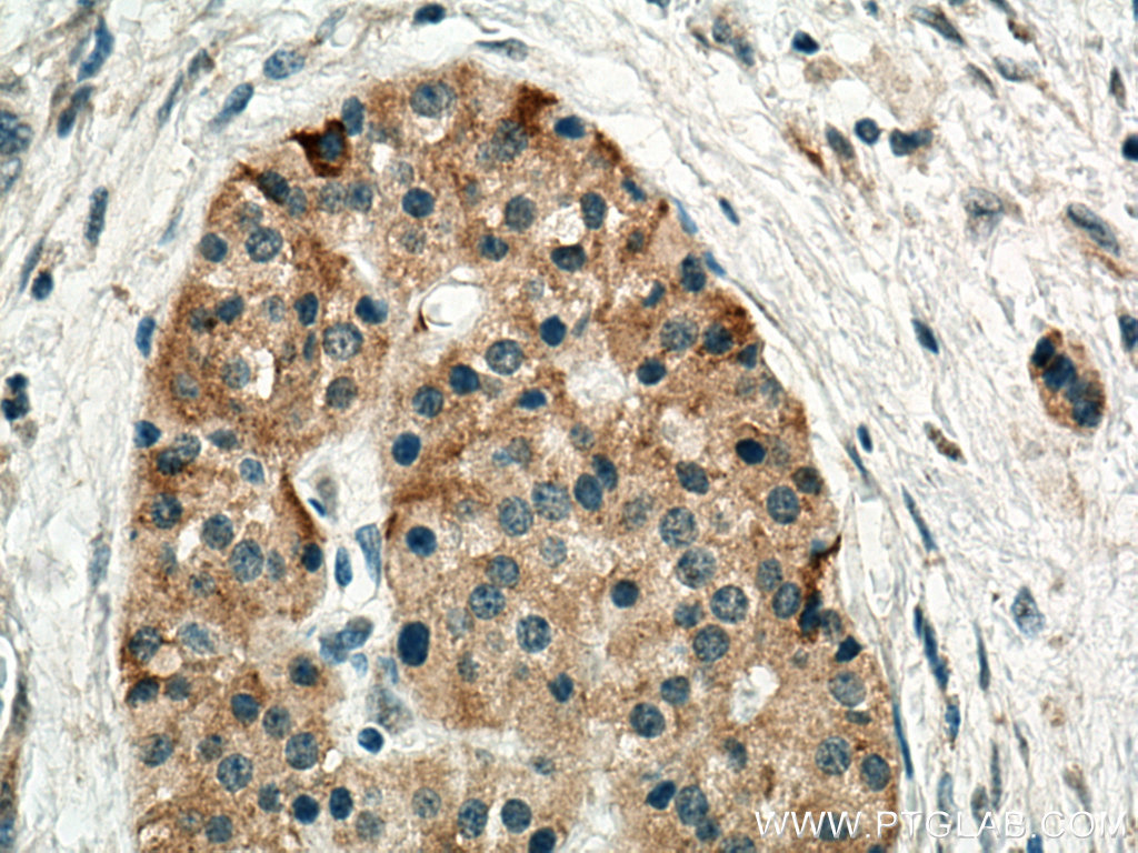 IHC staining of human pancreas cancer using 25507-1-AP