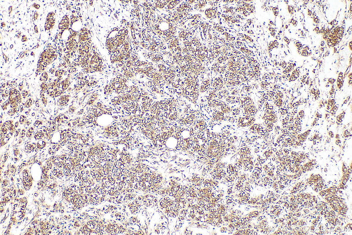 IHC staining of human breast cancer using 27267-1-AP