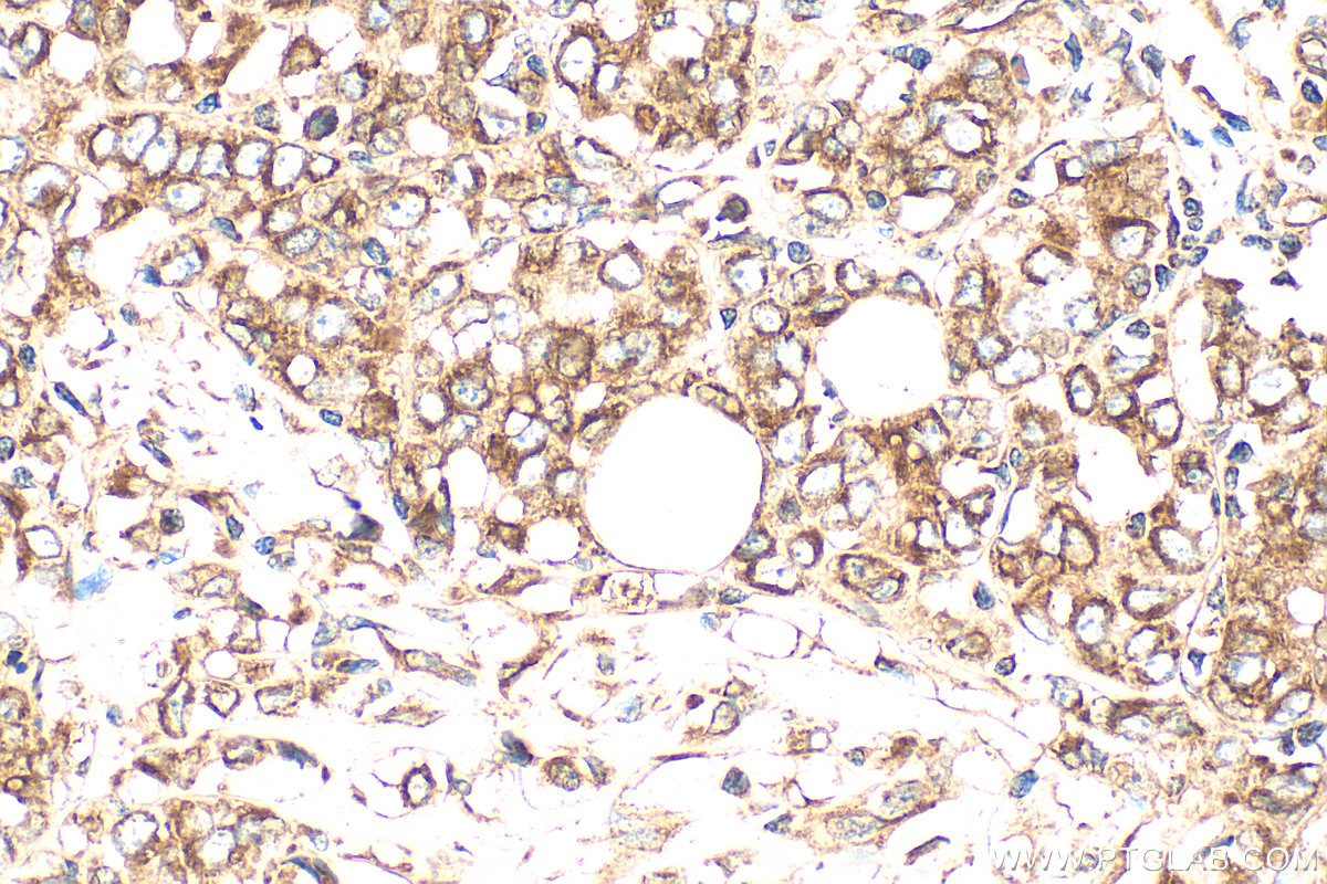 IHC staining of human breast cancer using 27267-1-AP