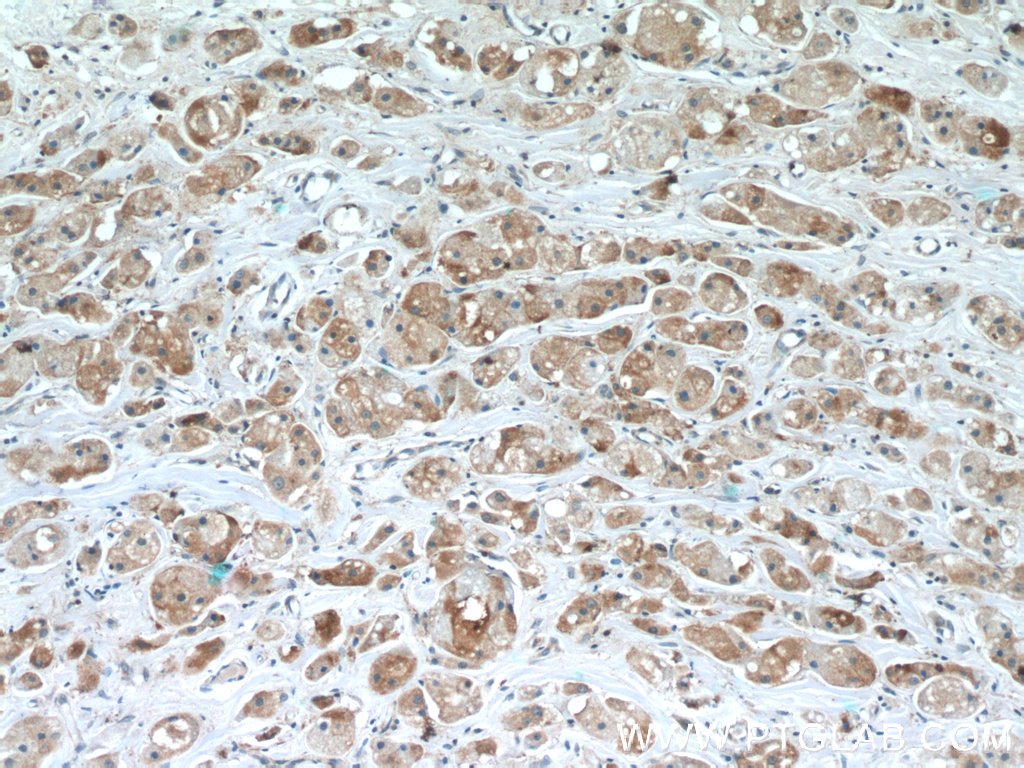 IHC staining of human breast cancer using 24134-1-AP