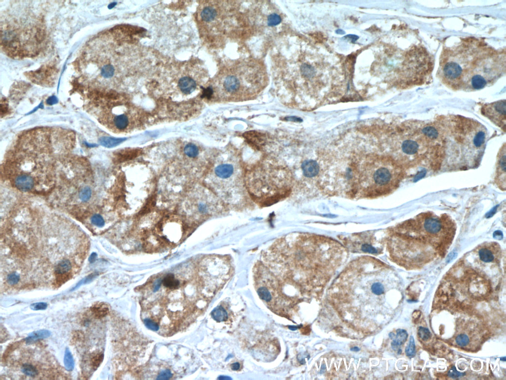 IHC staining of human breast cancer using 24134-1-AP