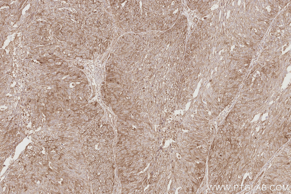IHC staining of human ovary cancer using 83656-3-RR IHC staining of human ovary cancer using 83656-3-RR