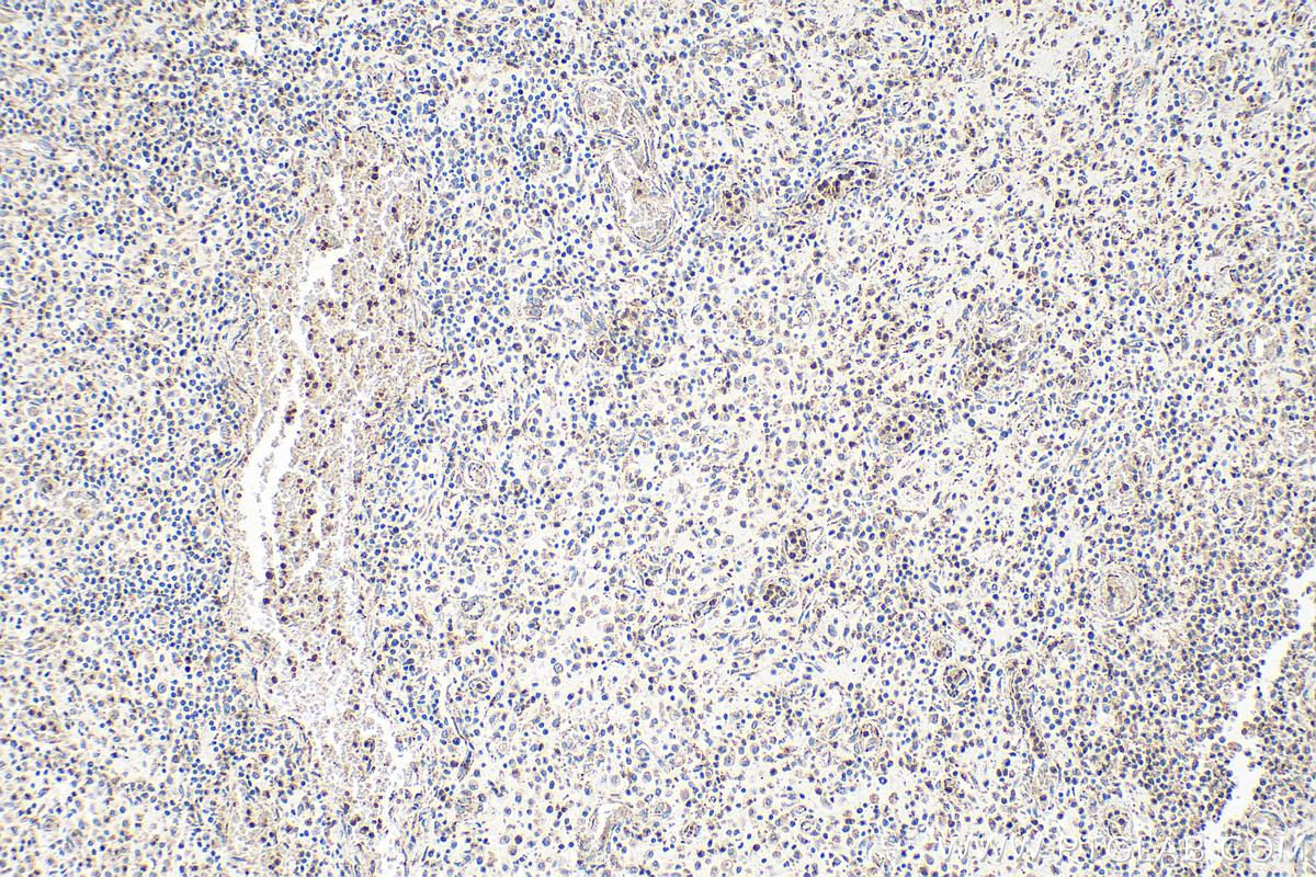 IHC staining of human colon cancer using 21913-1-AP (same clone as 21913-1-PBS)