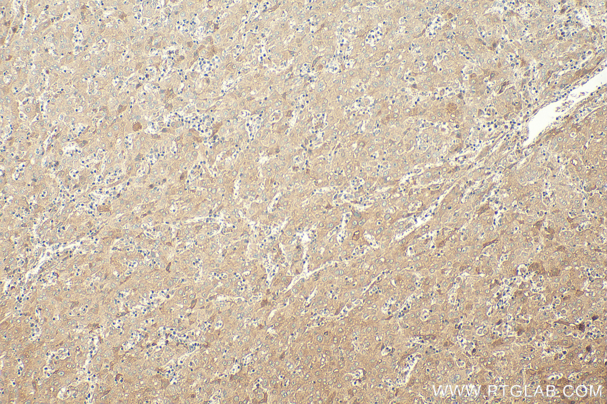 IHC staining of human liver cancer using 21913-1-AP