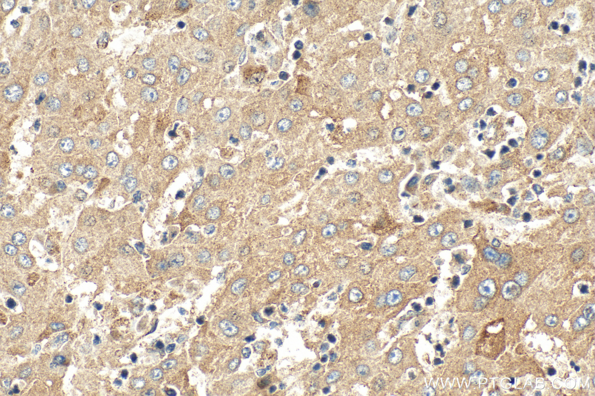IHC staining of human liver cancer using 21913-1-AP