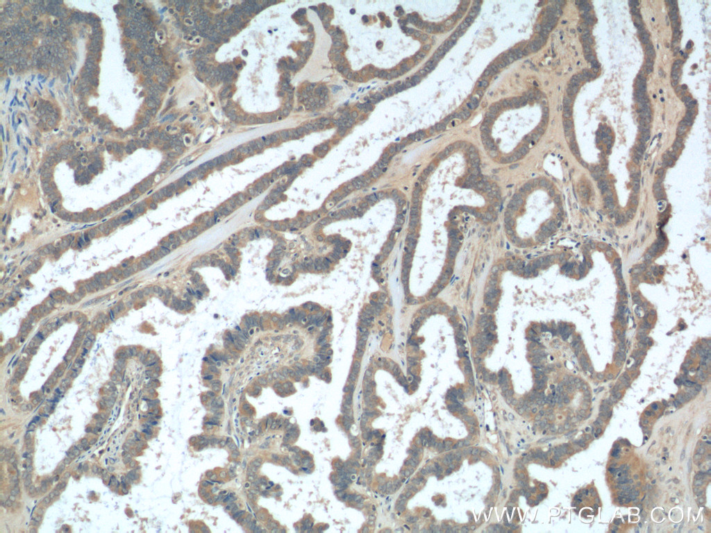 IHC staining of human ovary tumor using 23182-1-AP