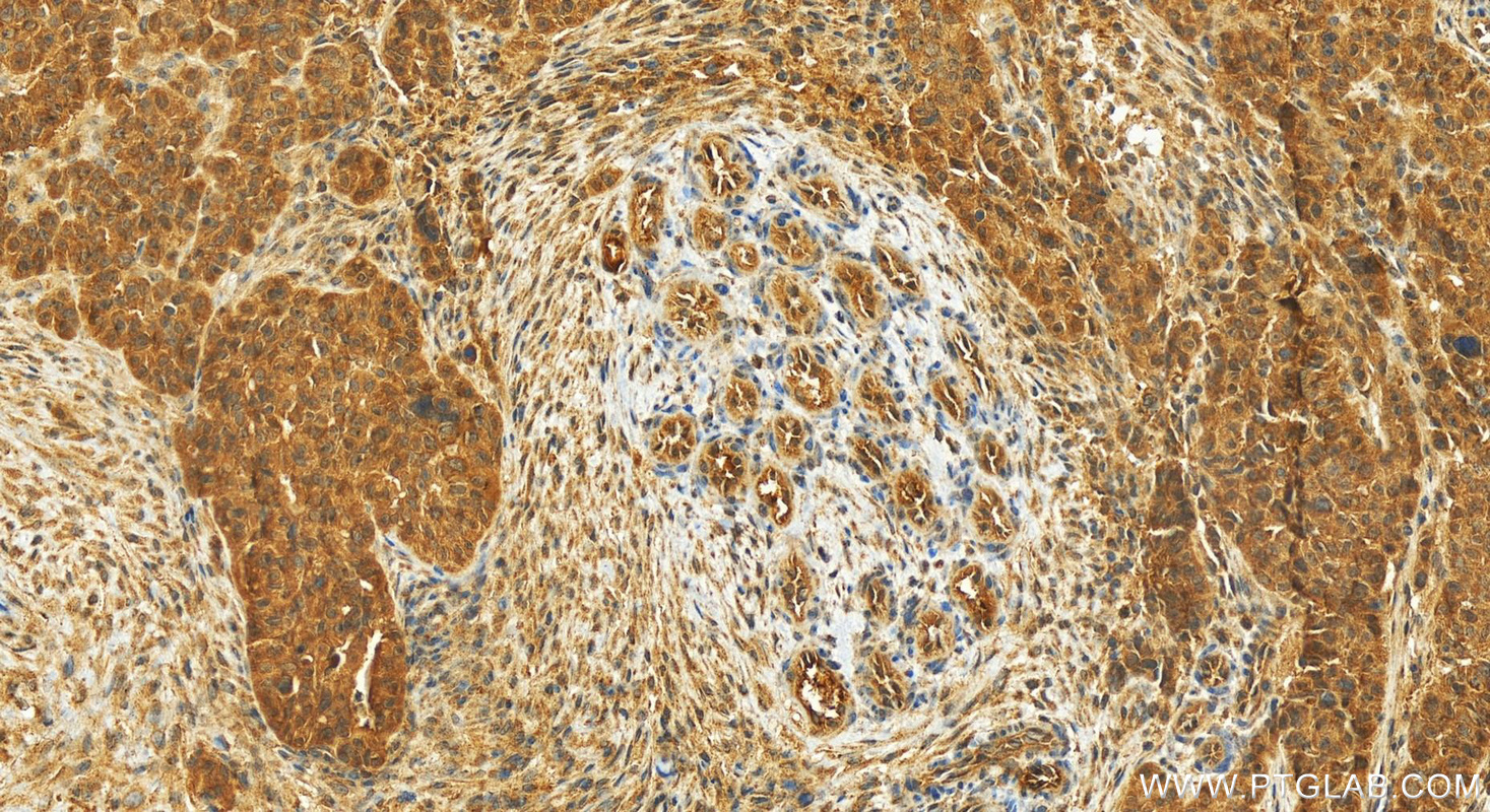 IHC staining of human ovarian cancer using 23182-1-AP