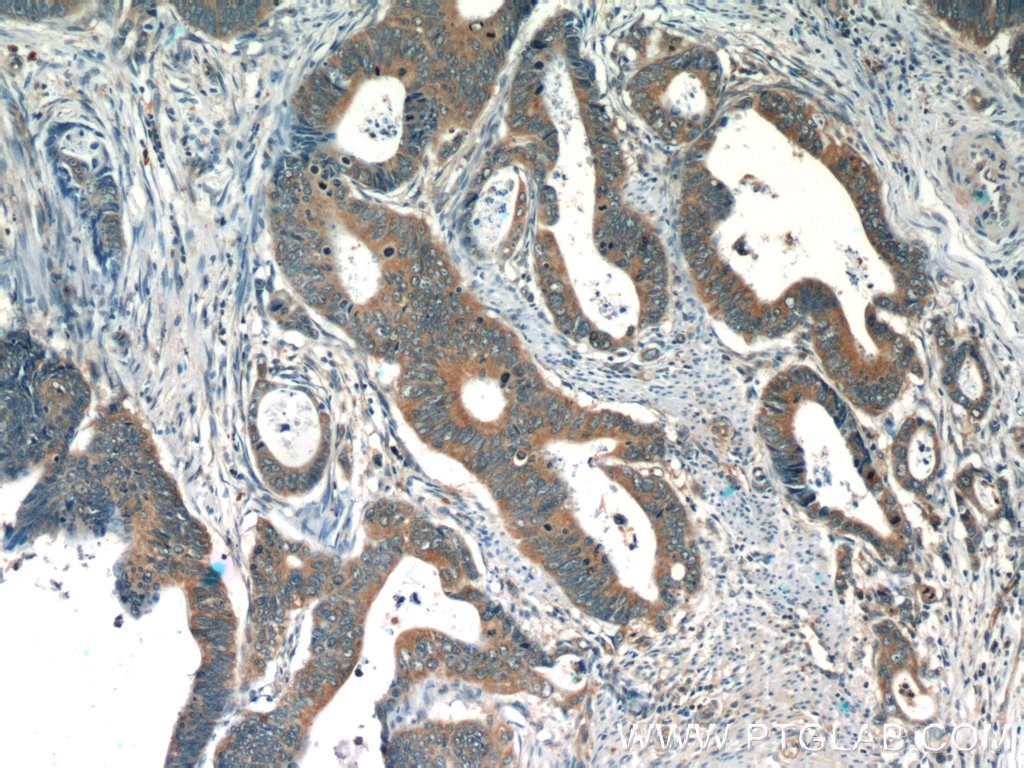 IHC staining of human colon cancer using 22212-1-AP