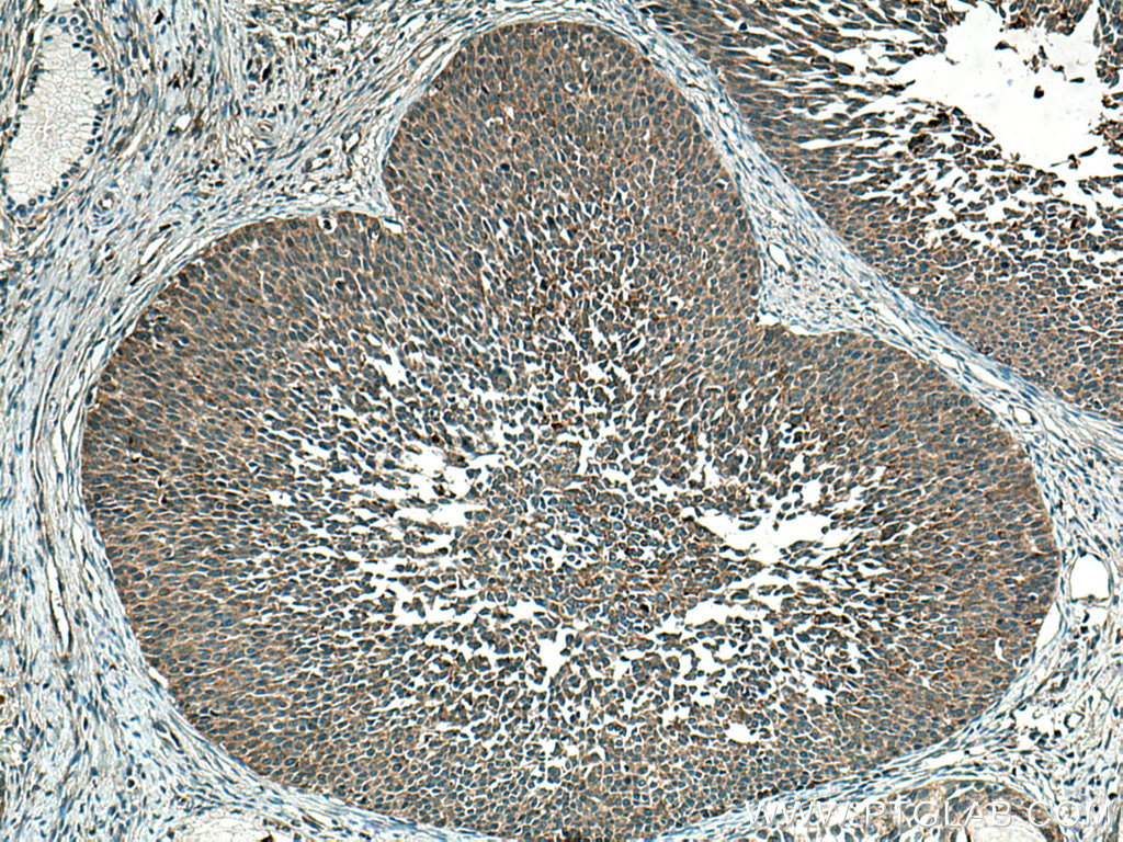 IHC staining of human cervical cancer using 19728-1-AP