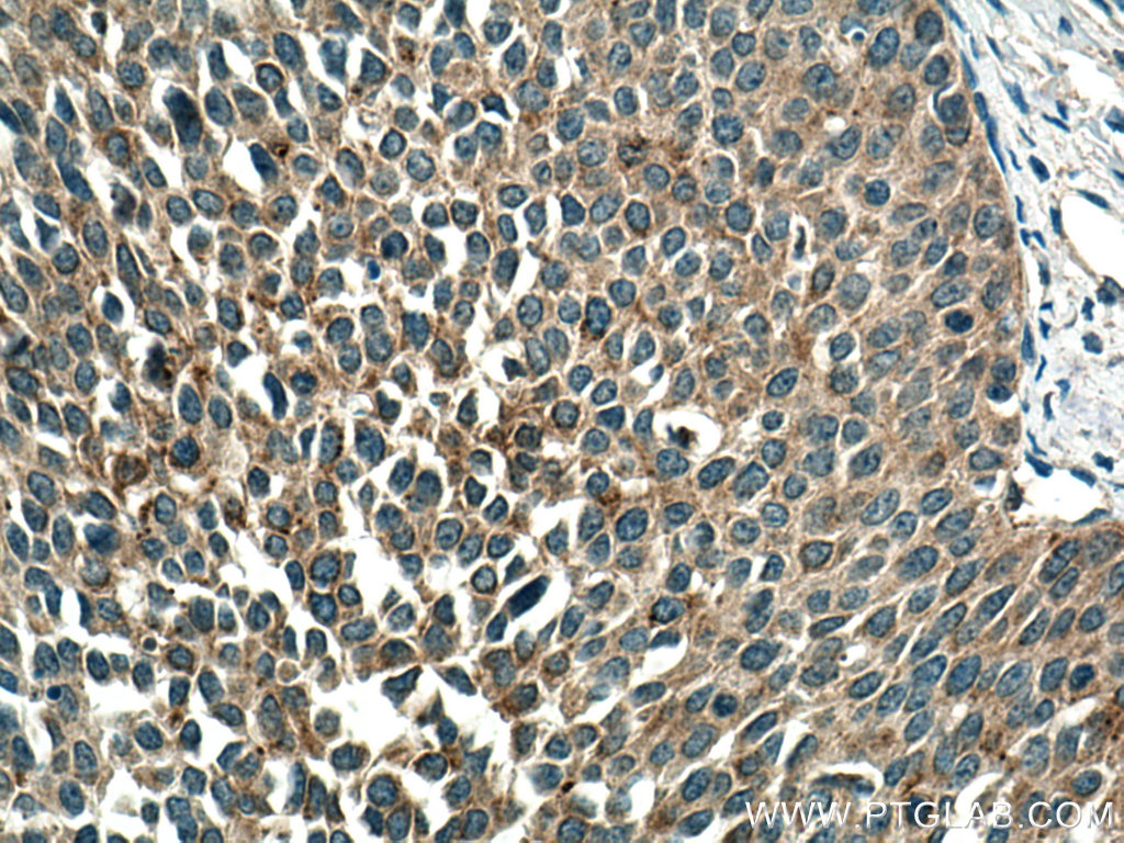 IHC staining of human cervical cancer using 19728-1-AP