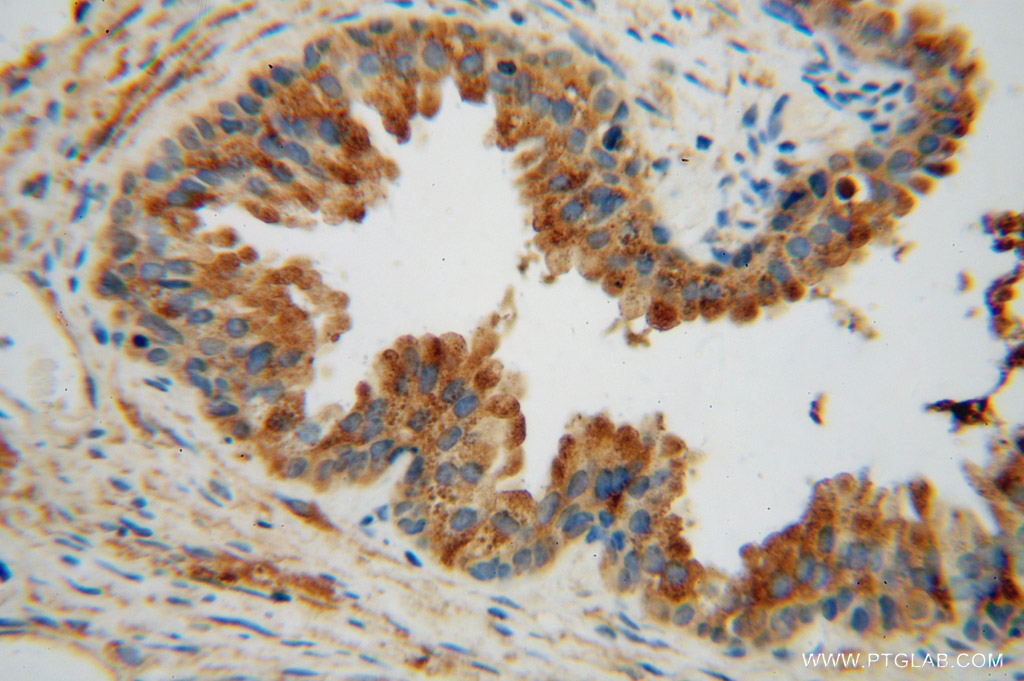 IHC staining of human gliomas using 15262-1-AP