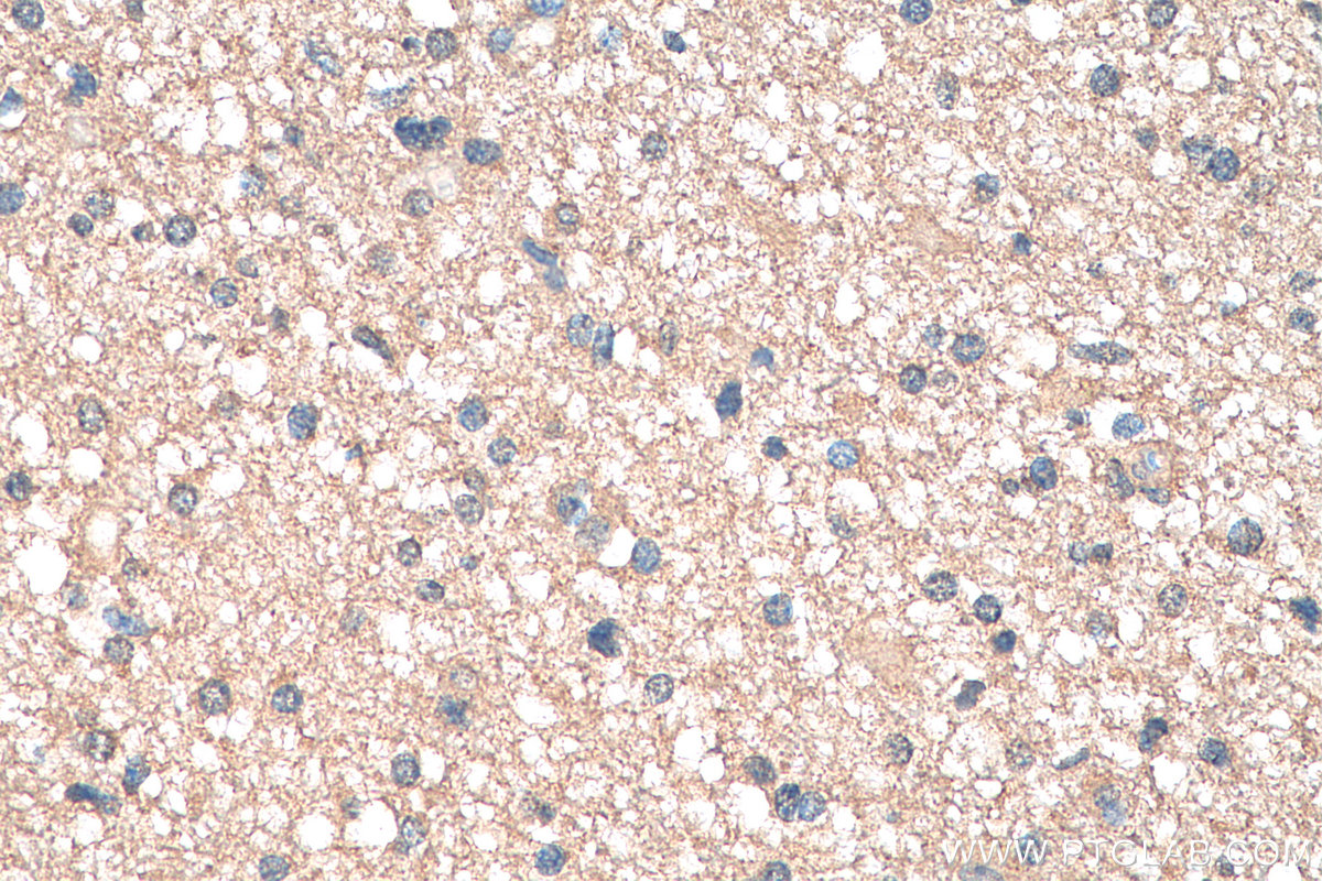 IHC staining of human gliomas using 68039-1-Ig