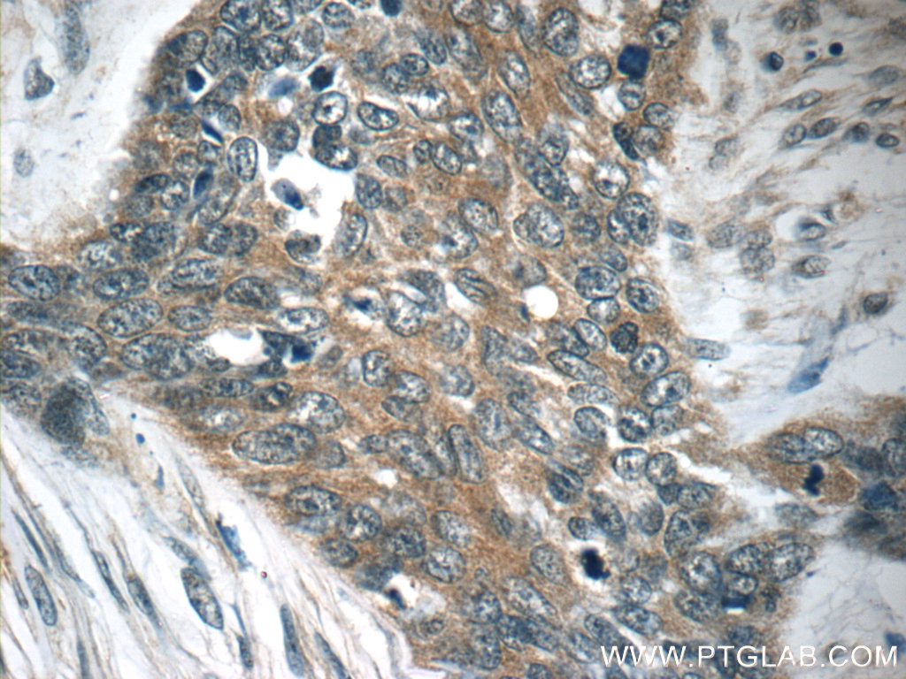 IHC staining of human skin cancer using 51149-1-AP (same clone as 51149-1-PBS)