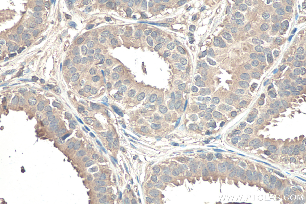 IHC staining of human breast cancer using 67710-1-Ig