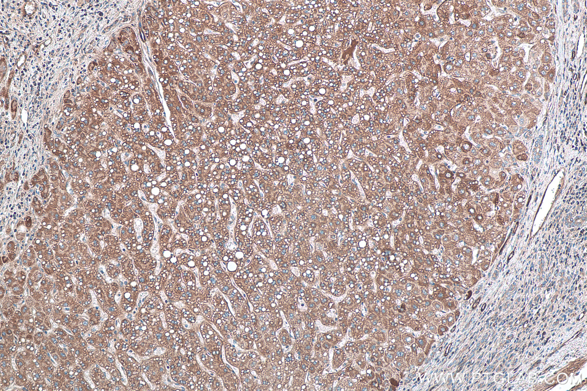 IHC staining of human liver cancer using 27789-1-AP