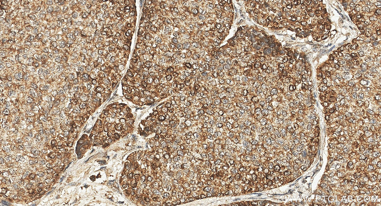 IHC staining of human breast cancer using 60291-1-Ig
