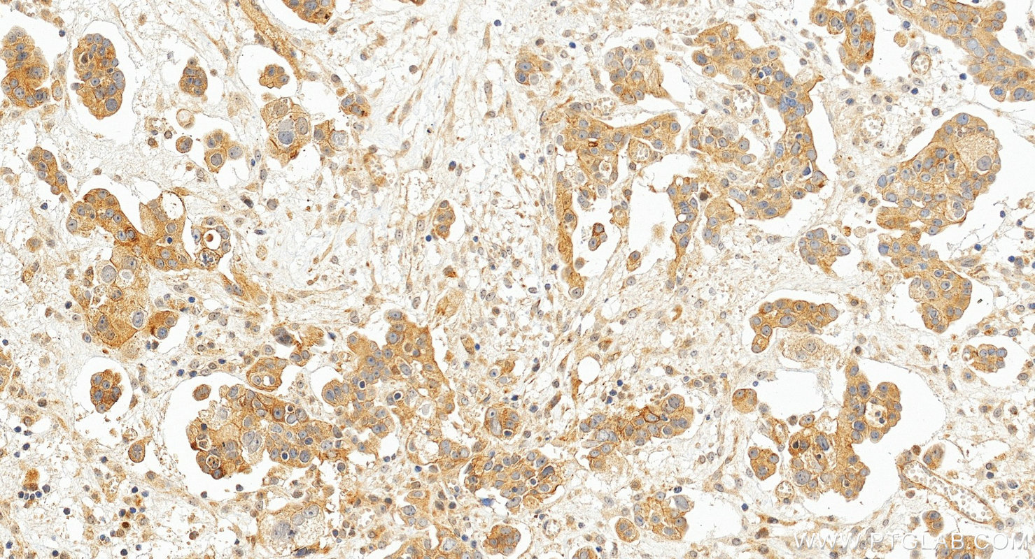 IHC staining of human ovary cancer using 17590-1-AP (same clone as 17590-1-PBS)