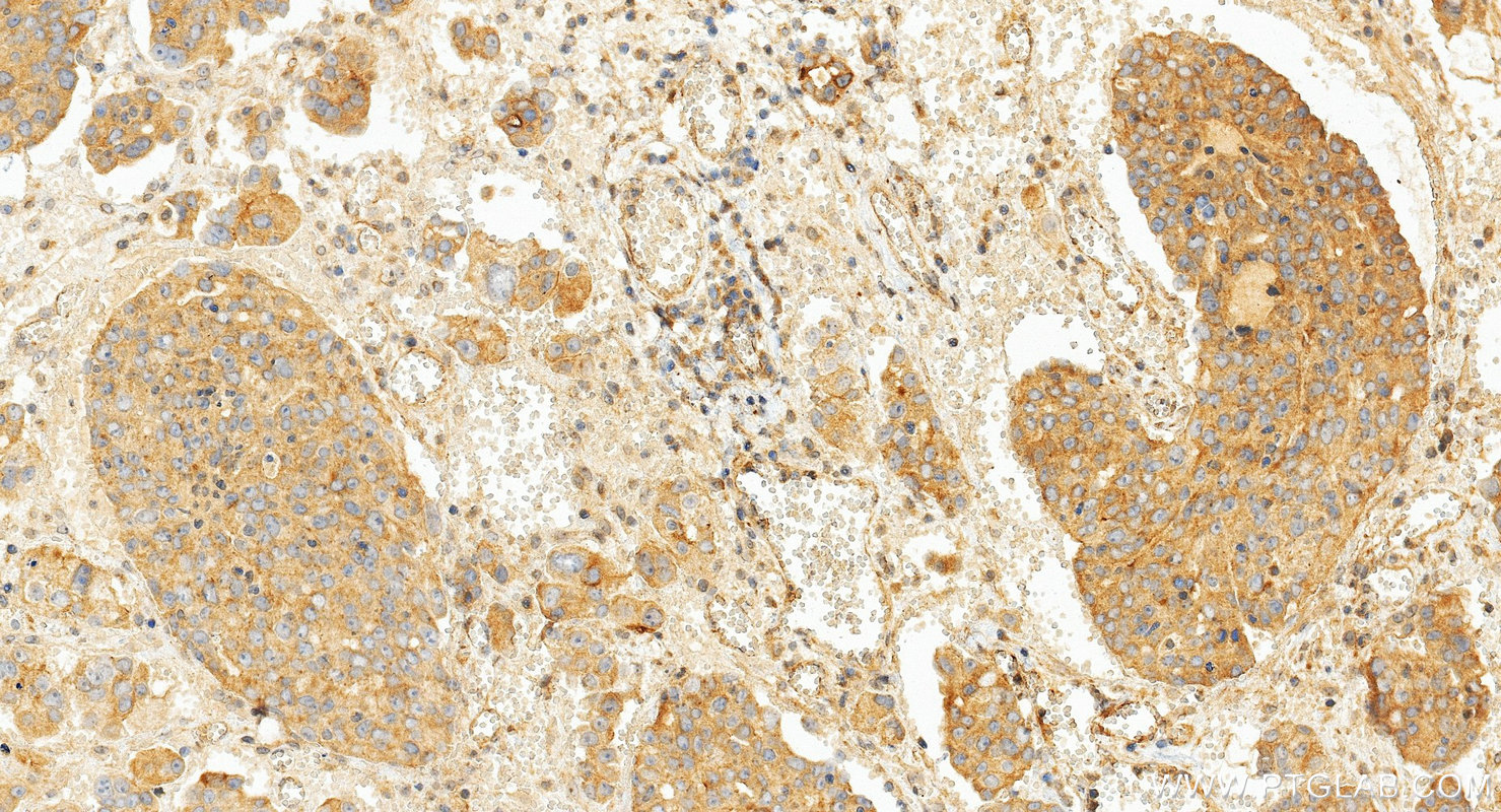 IHC staining of human ovary cancer using 17590-1-AP (same clone as 17590-1-PBS)