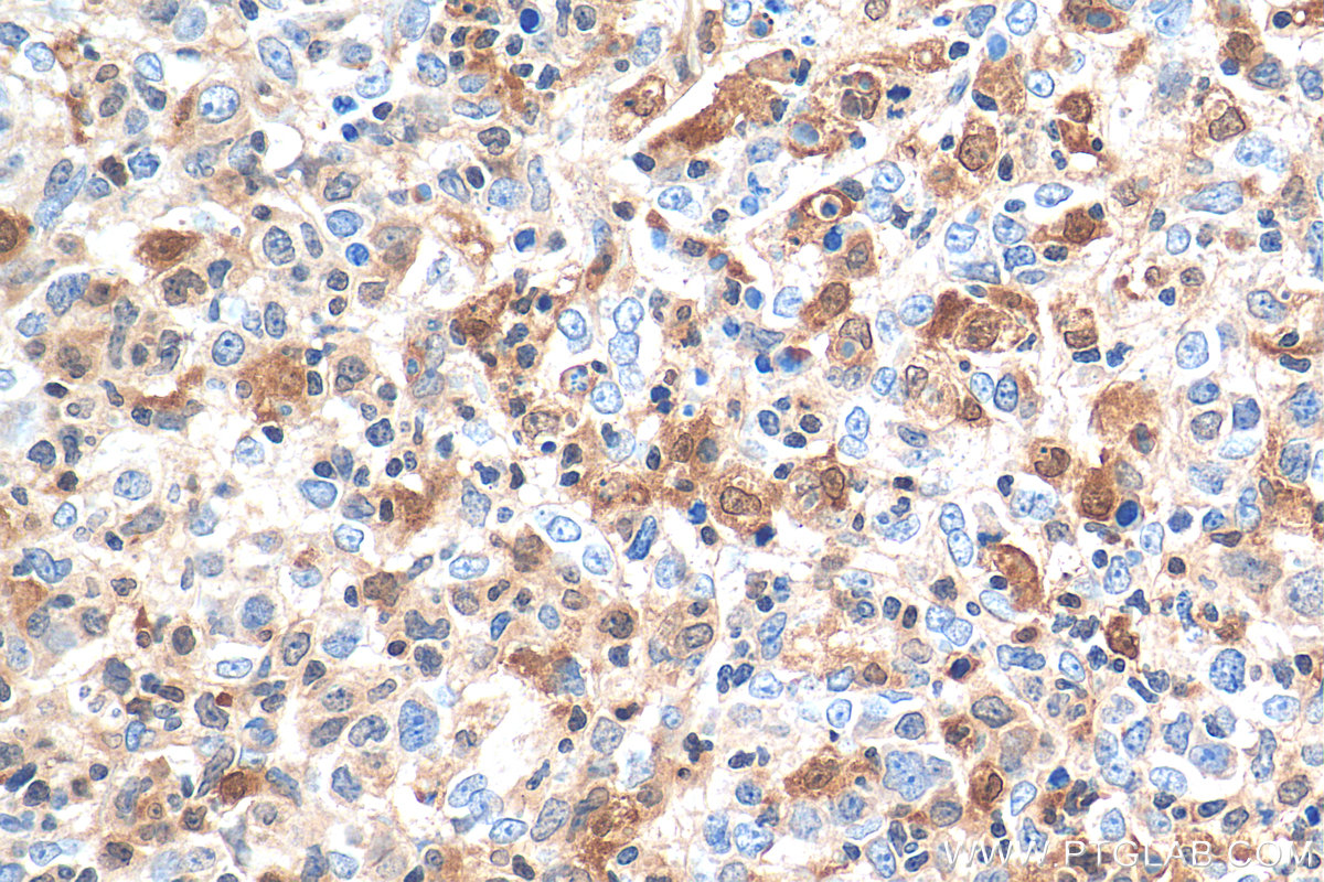 IHC staining of human lymphoma using 15940-1-AP
