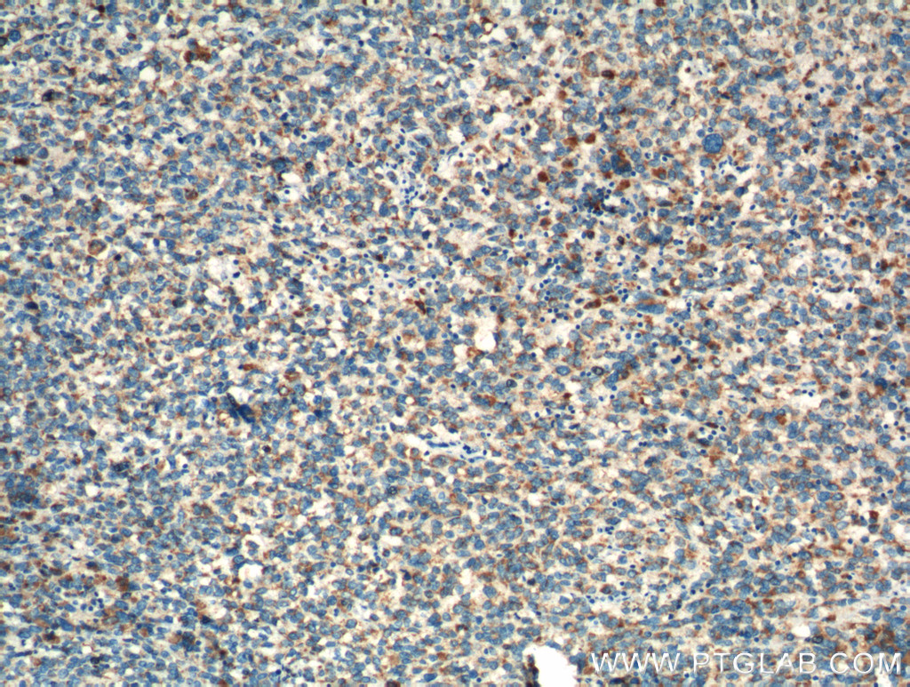 IHC staining of human malignant melanoma using 13111-1-AP