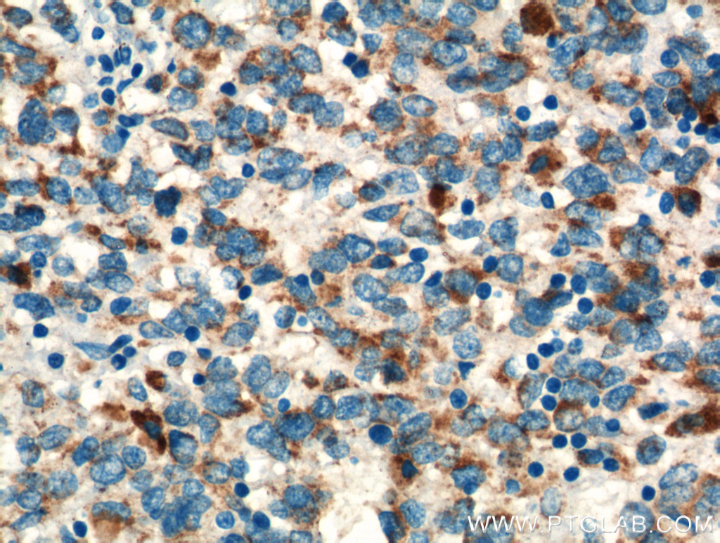 IHC staining of human malignant melanoma using 13111-1-AP