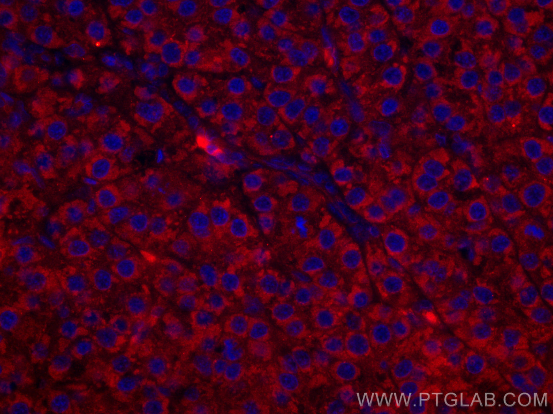IF Staining of human liver cancer using CL594-60192