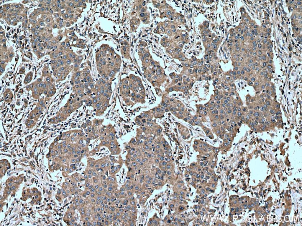 IHC staining of human breast cancer using 27724-1-AP (same clone as 27724-1-PBS)