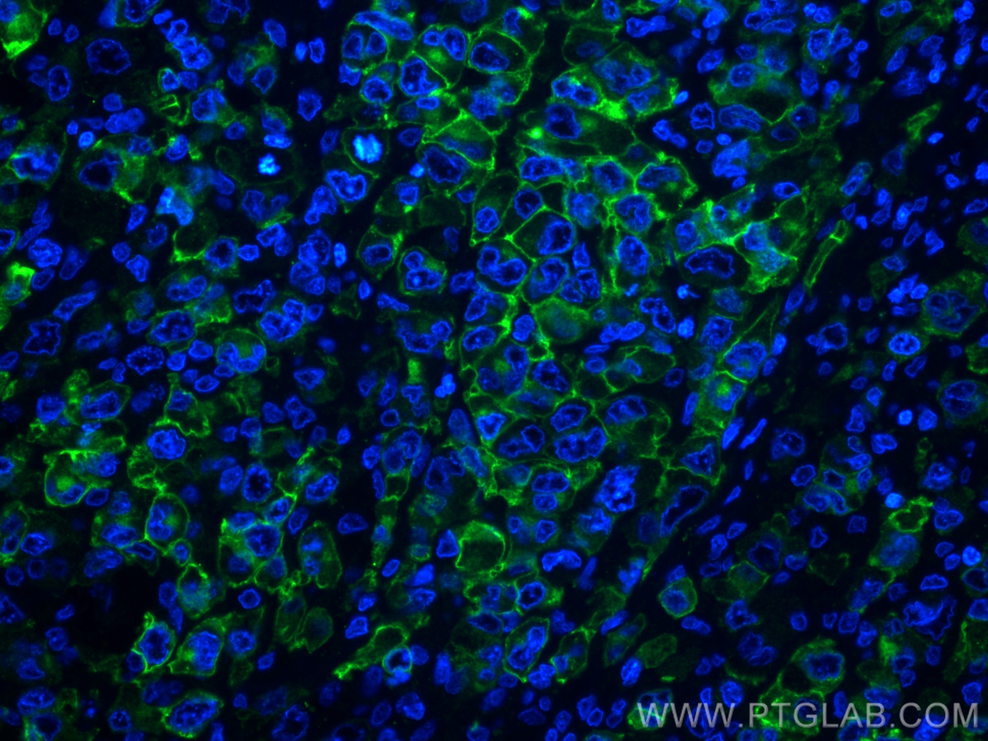 IF Staining of human lymphoma using 55132-1-AP