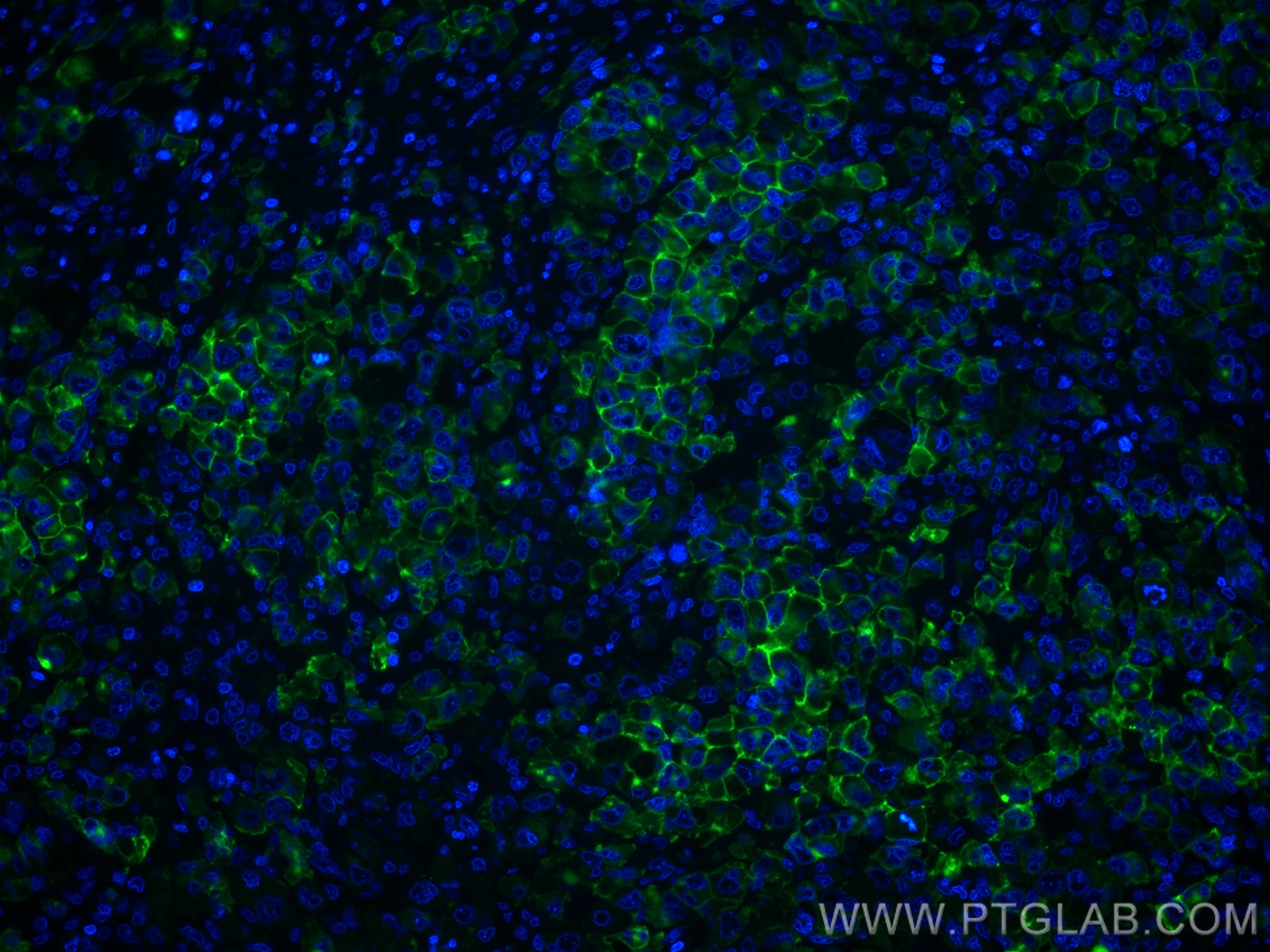 IF Staining of human lymphoma using 55132-1-AP