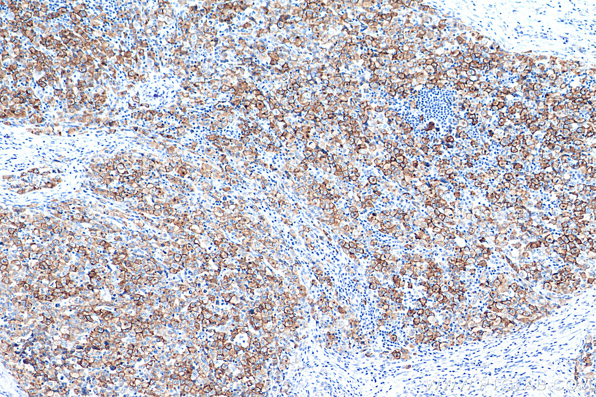 IHC staining of human lymphoma using 55132-1-AP