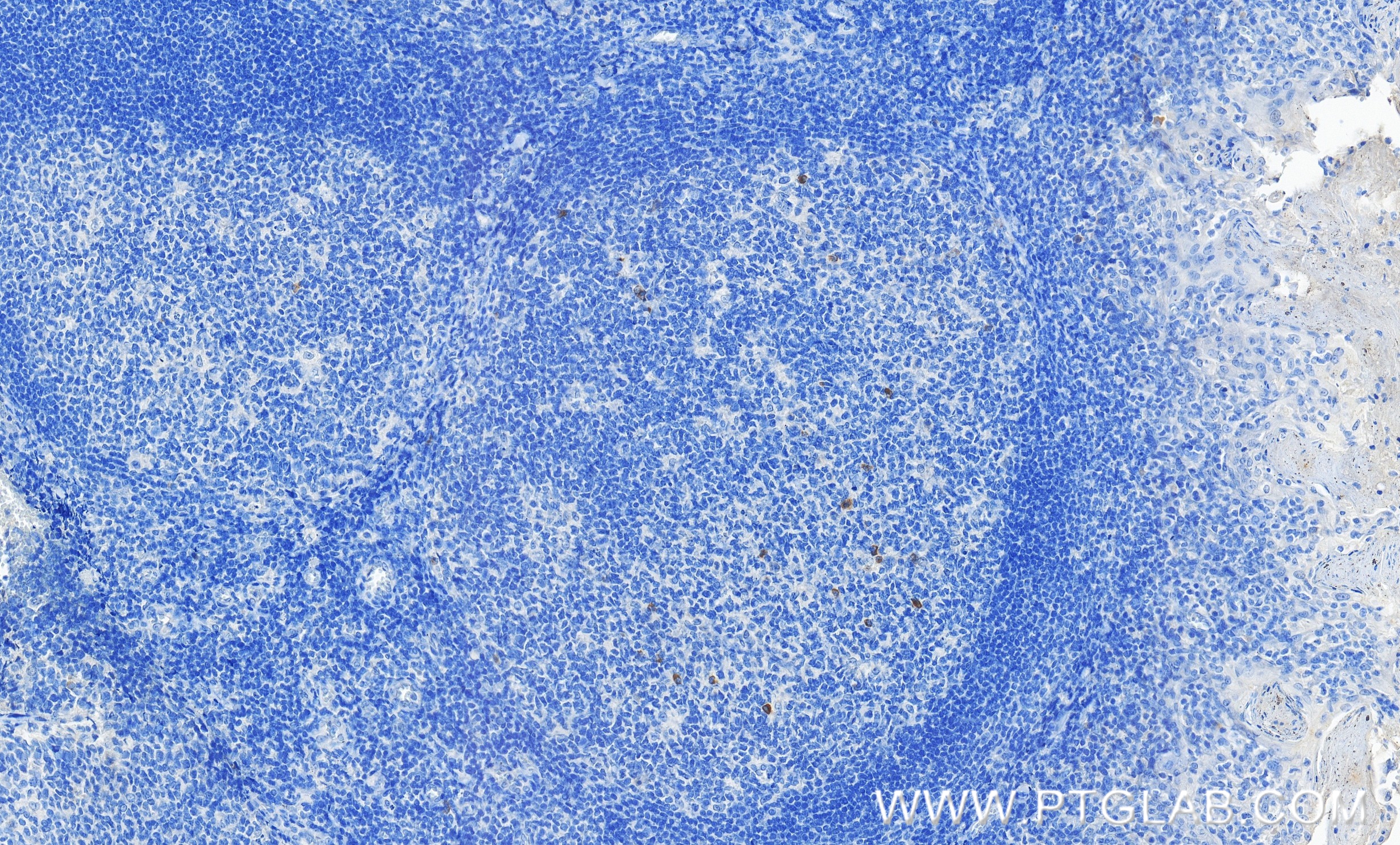 Immunohistochemical analysis of paraffin-embedded human tonsillitis tissue slide using 98112-1-RR (TNFRSF9/CD137 antibody) at dilution of 1:200 (under 40x lens). Heat mediated antigen retrieval with Tris-EDTA buffer (pH 9.0). IHC staining of human tonsillitis using 98112-1-RR