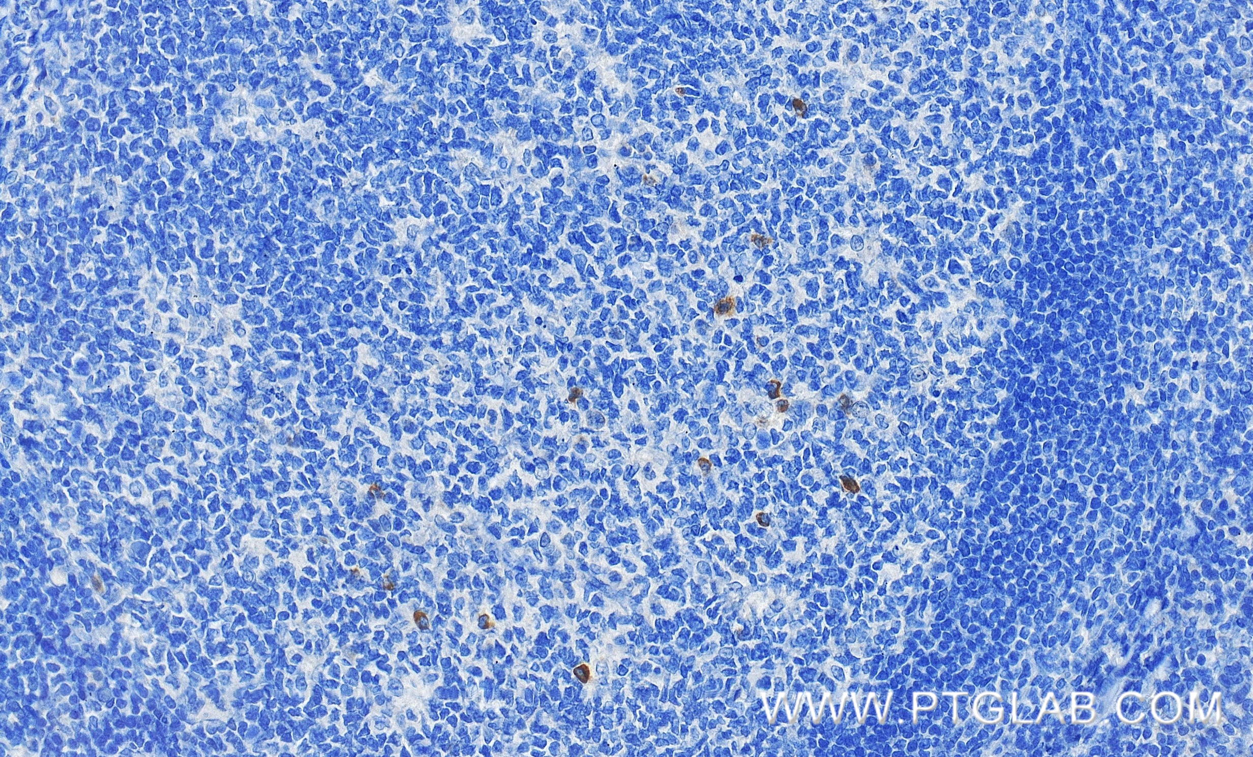 Immunohistochemical analysis of paraffin-embedded human tonsillitis tissue slide using 98112-1-RR (TNFRSF9/CD137 antibody) at dilution of 1:200 (under 40x lens). Heat mediated antigen retrieval with Tris-EDTA buffer (pH 9.0). IHC staining of human tonsillitis using 98112-1-RR