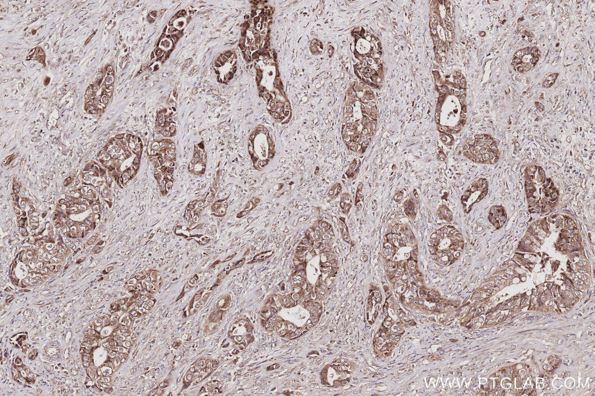 IHC staining of human pancreas cancer using 84231-4-RR IHC staining of human pancreas cancer using 84231-4-RR