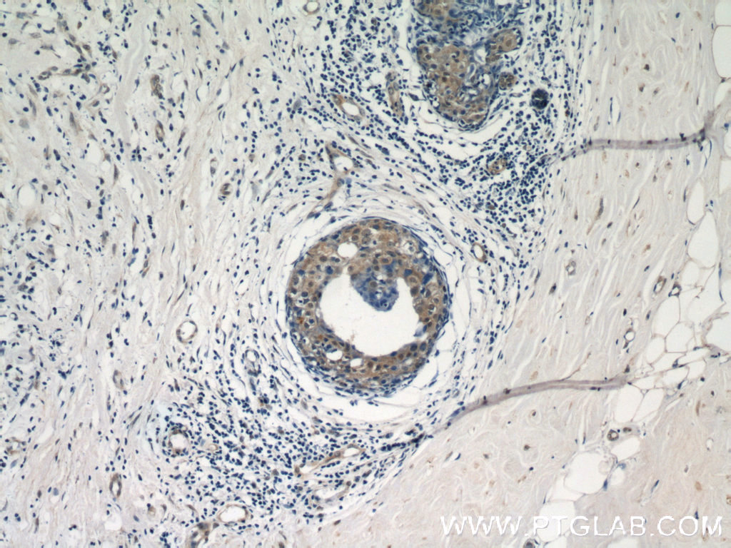 IHC staining of human breast cancer using 14304-1-AP