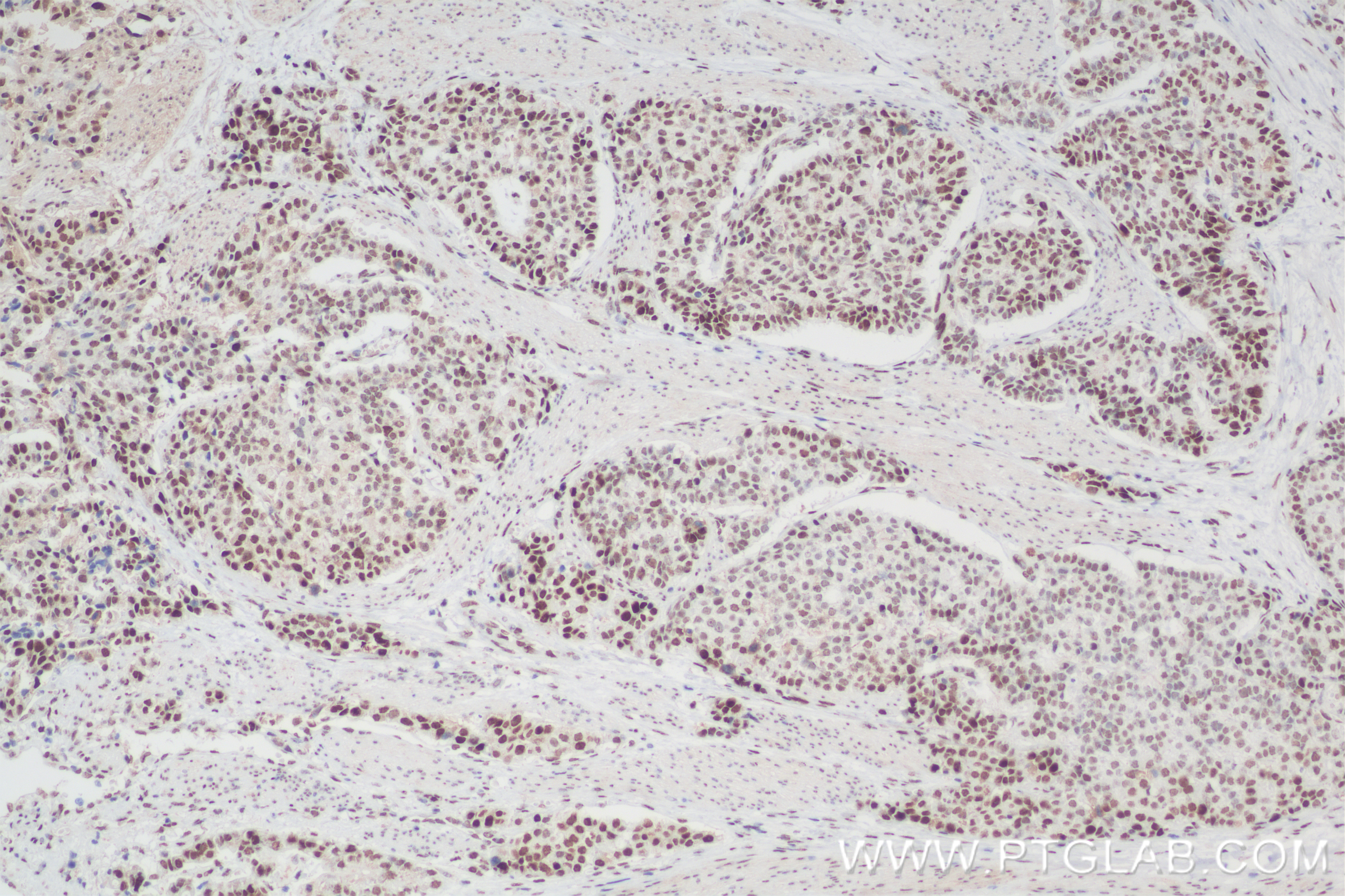 IHC staining of human stomach cancer using 83944-2-RR