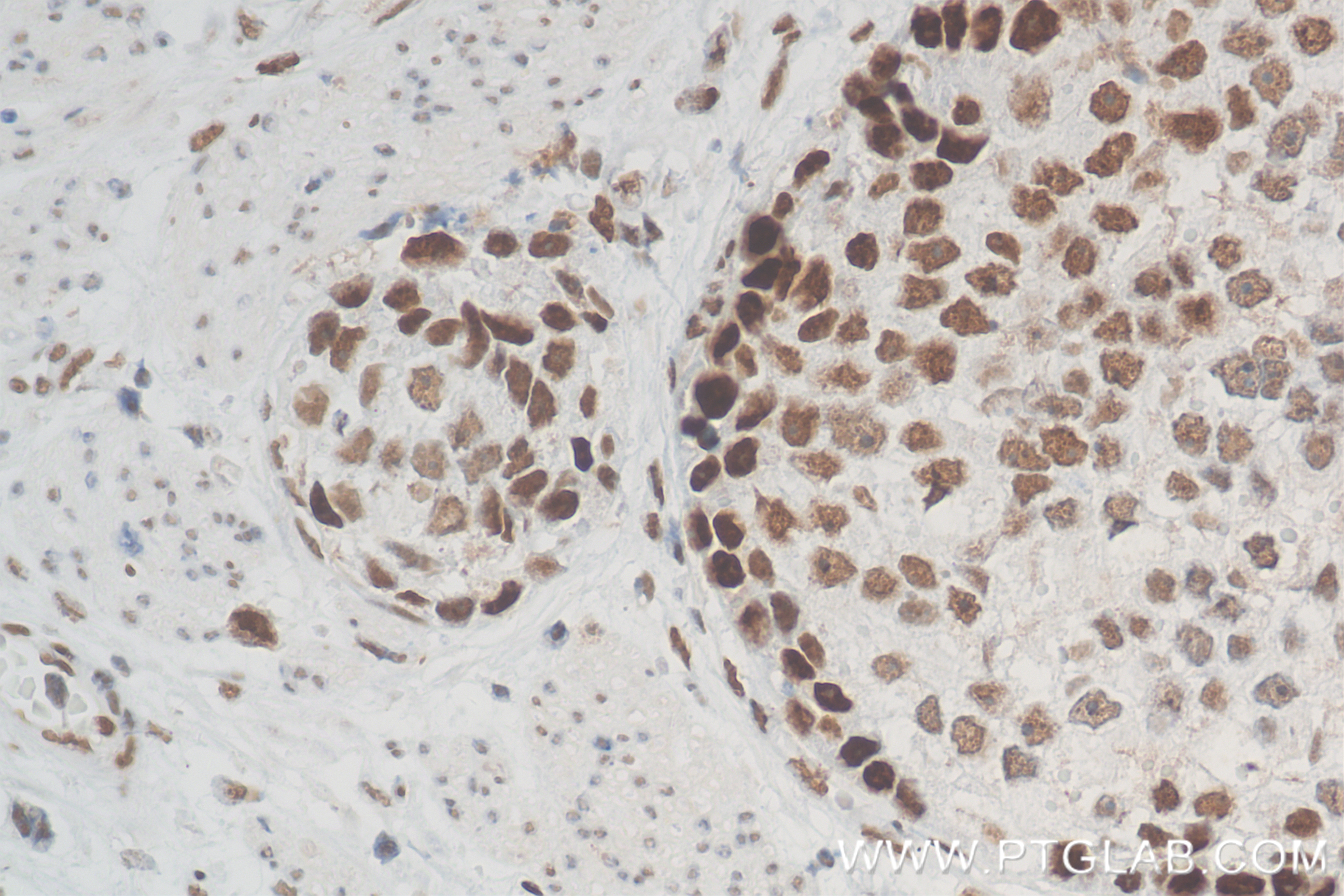 IHC staining of human stomach cancer using 83944-2-RR
