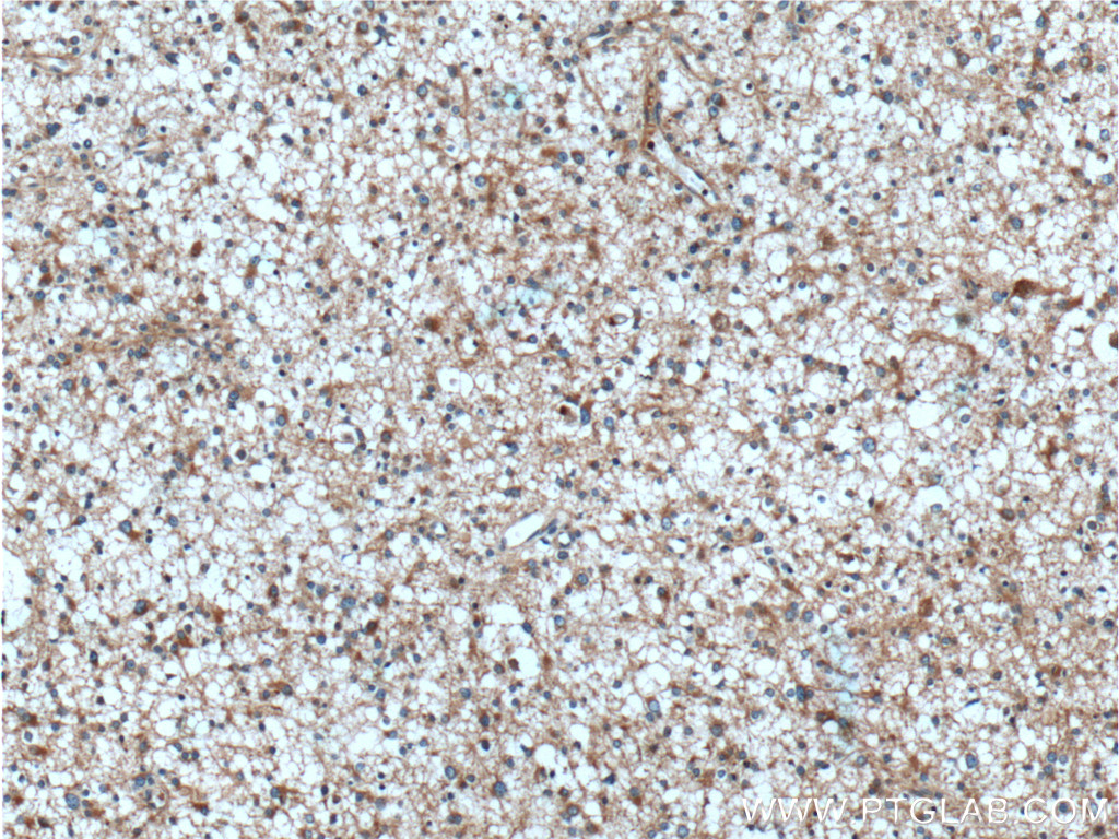IHC staining of human gliomas using 11315-1-AP