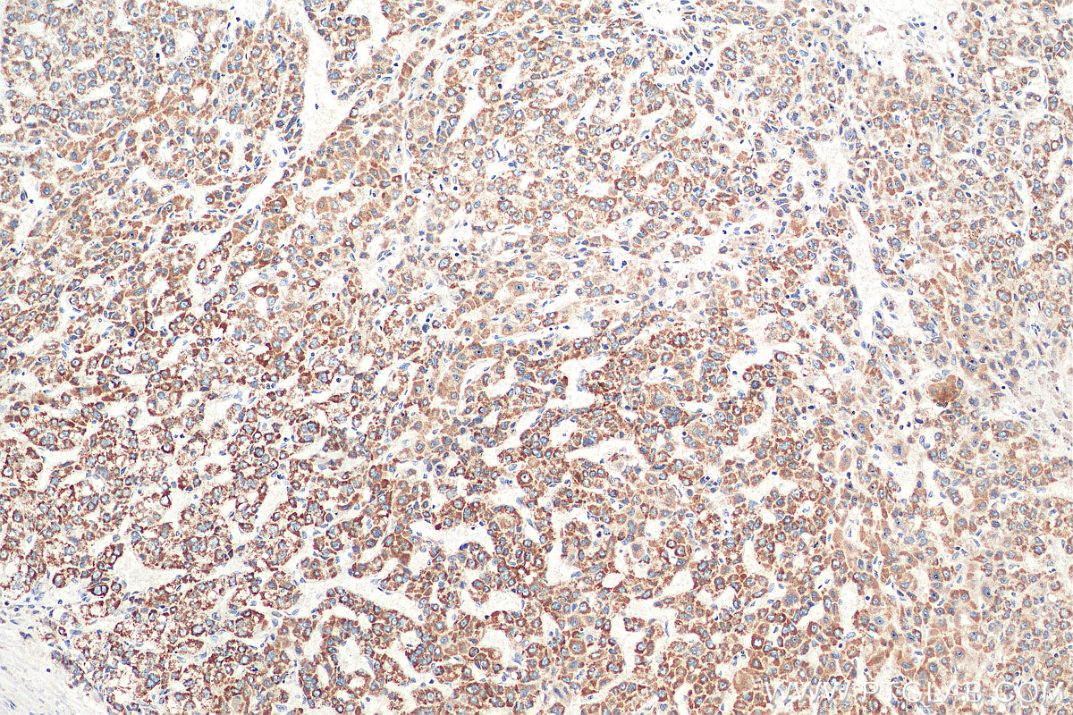 IHC staining of human liver cancer using 66777-1-Ig