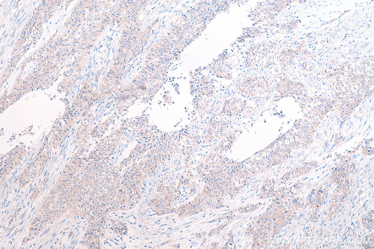 IHC staining of human urothelial carcinoma using 12196-1-AP