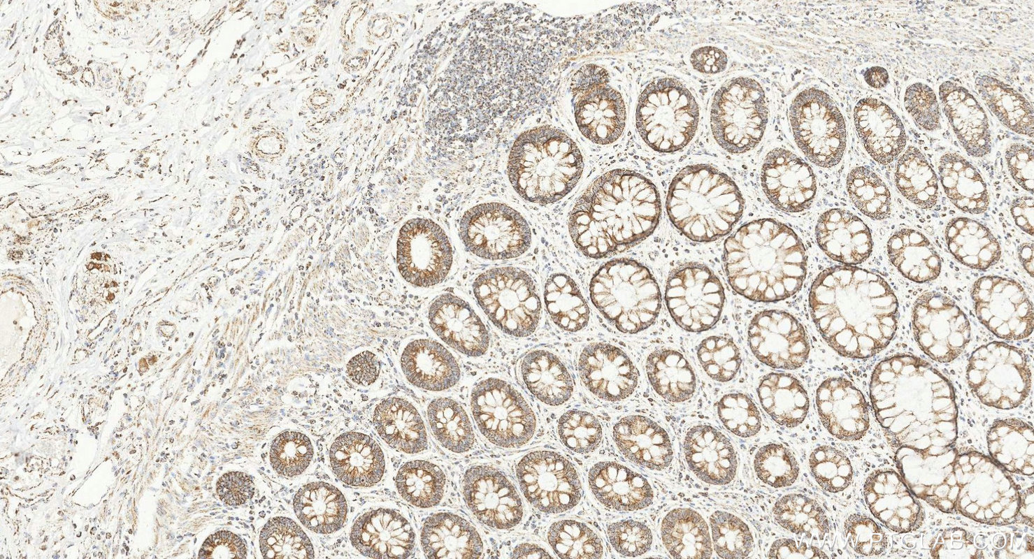 IHC staining of human colorectal cancer using 25607-1-AP (same clone as 25607-1-PBS) IHC staining of human colorectal cancer using 25607-1-AP (same clone as 25607-1-PBS)