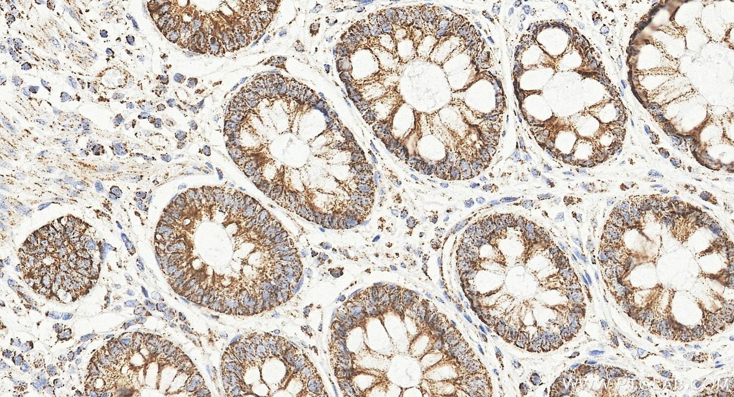 IHC staining of human colorectal cancer using 25607-1-AP (same clone as 25607-1-PBS) IHC staining of human colorectal cancer using 25607-1-AP (same clone as 25607-1-PBS)