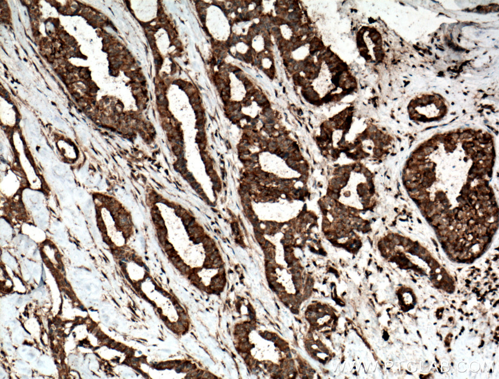 IHC staining of human breast cancer using 16689-1-AP