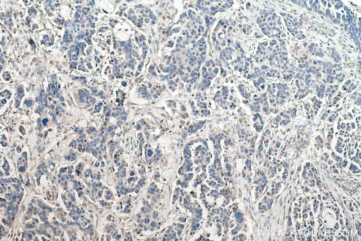 IHC staining of human colon cancer using 20705-1-AP