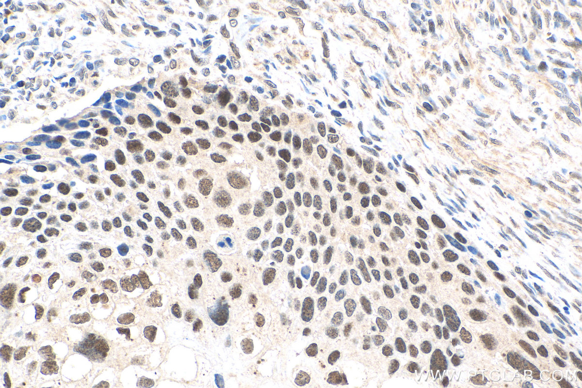 IHC staining of human cervical cancer using 20705-1-AP