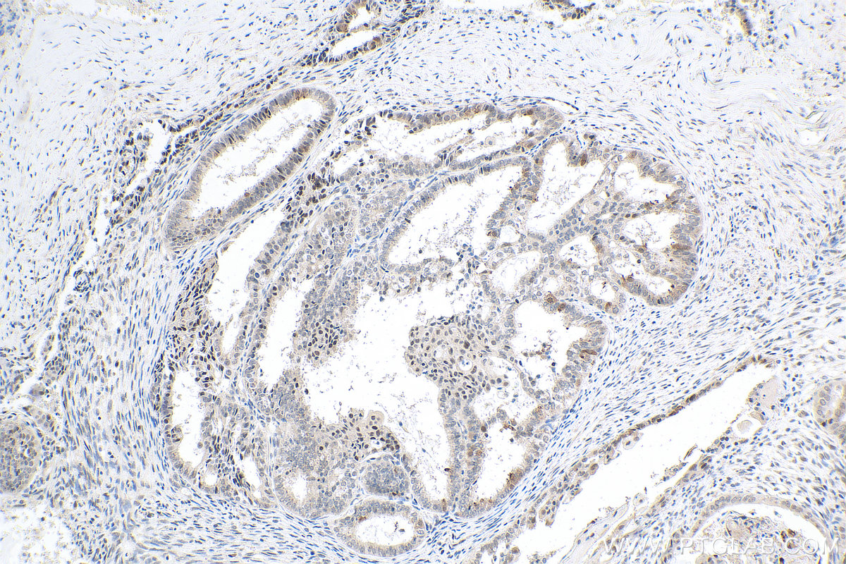 IHC staining of human ovary tumor using 20705-1-AP