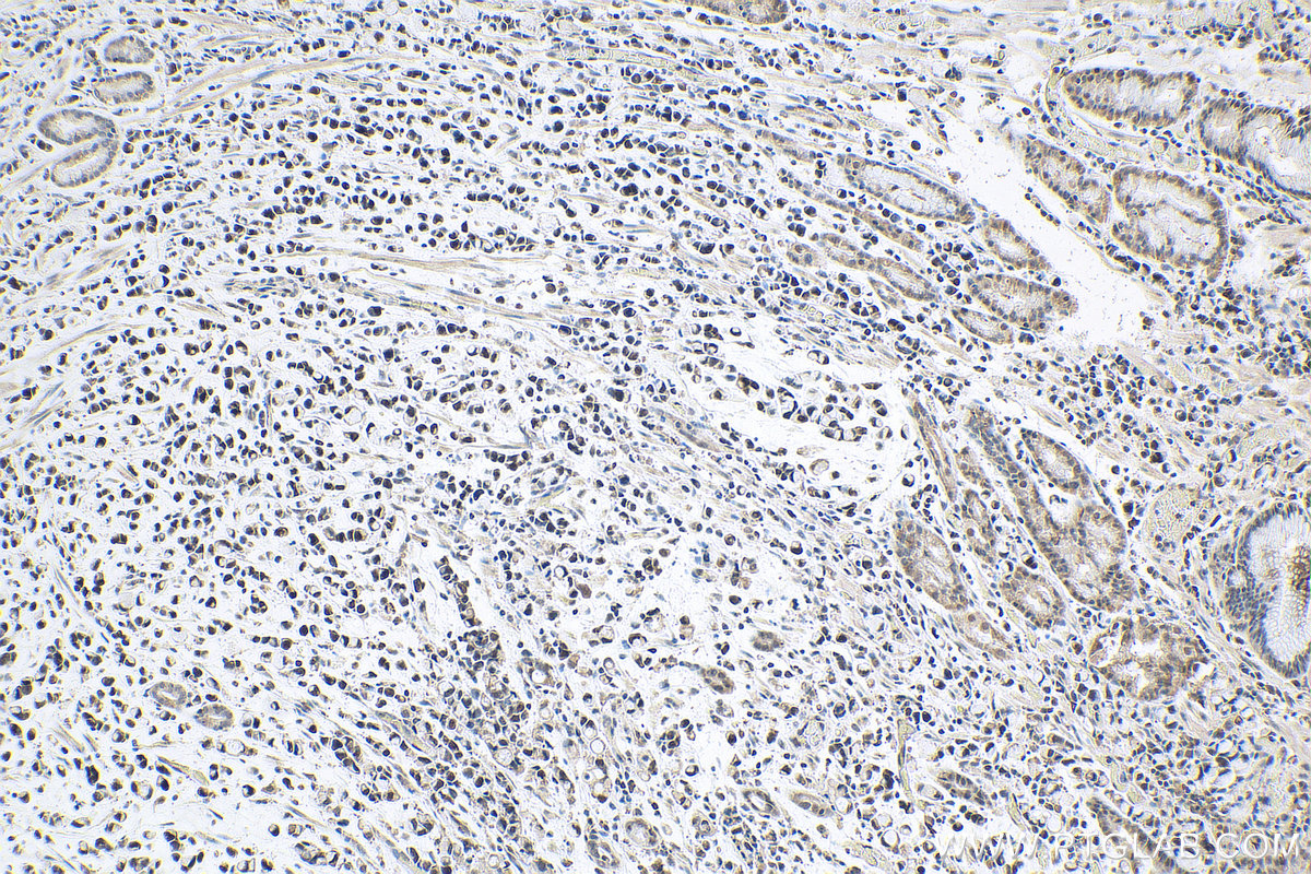 IHC staining of human stomach cancer using 20705-1-AP