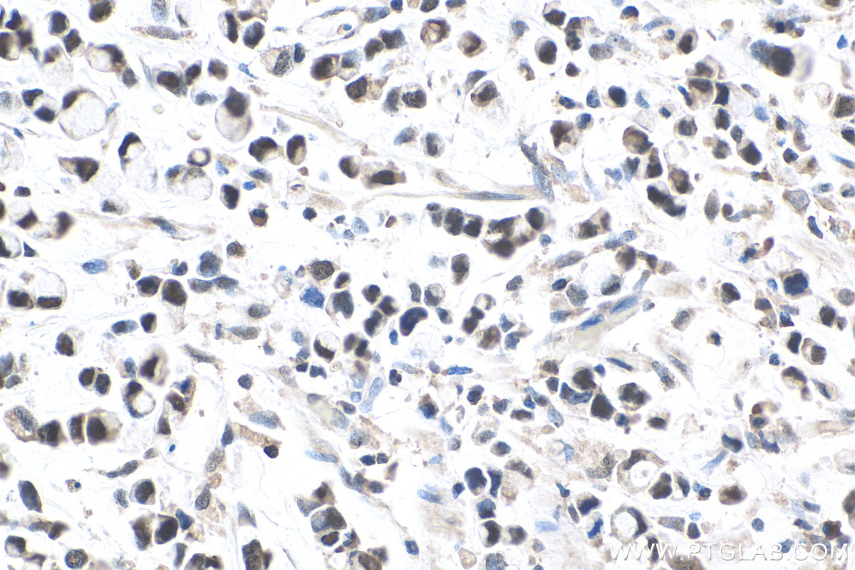 IHC staining of human stomach cancer using 20705-1-AP