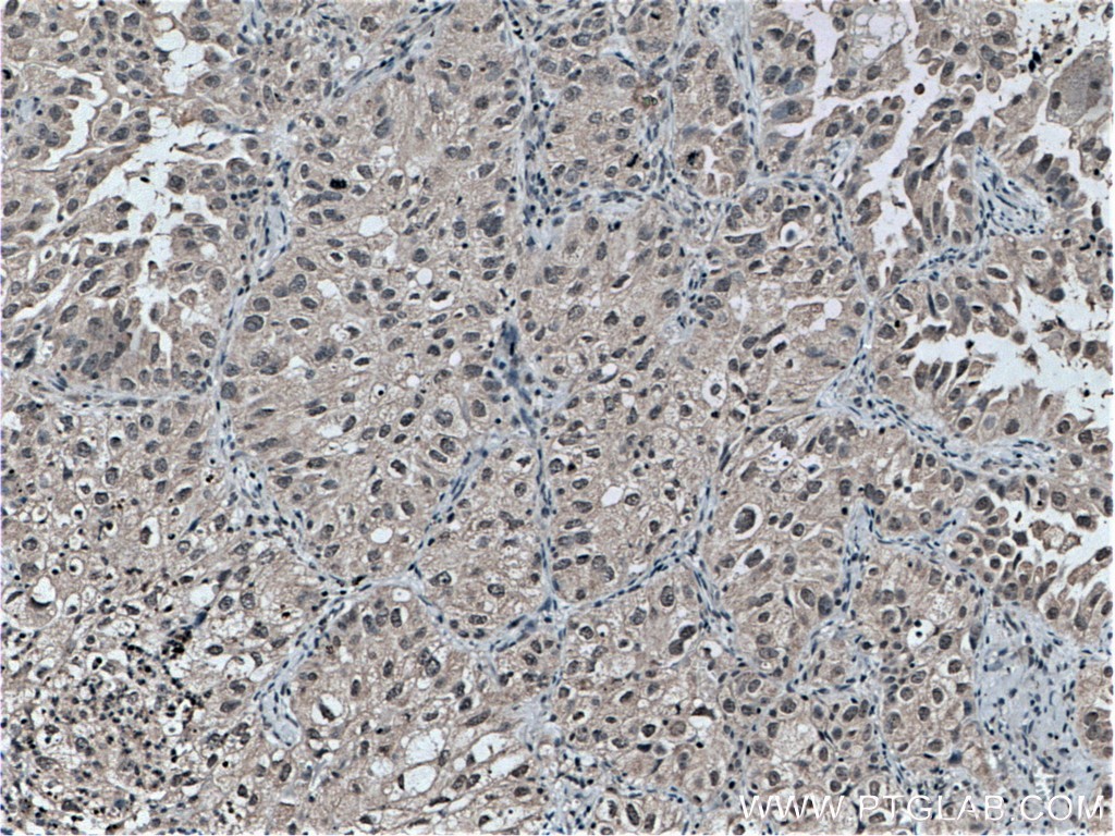 IHC staining of human lung cancer using 66541-1-Ig (same clone as 66541-1-PBS)