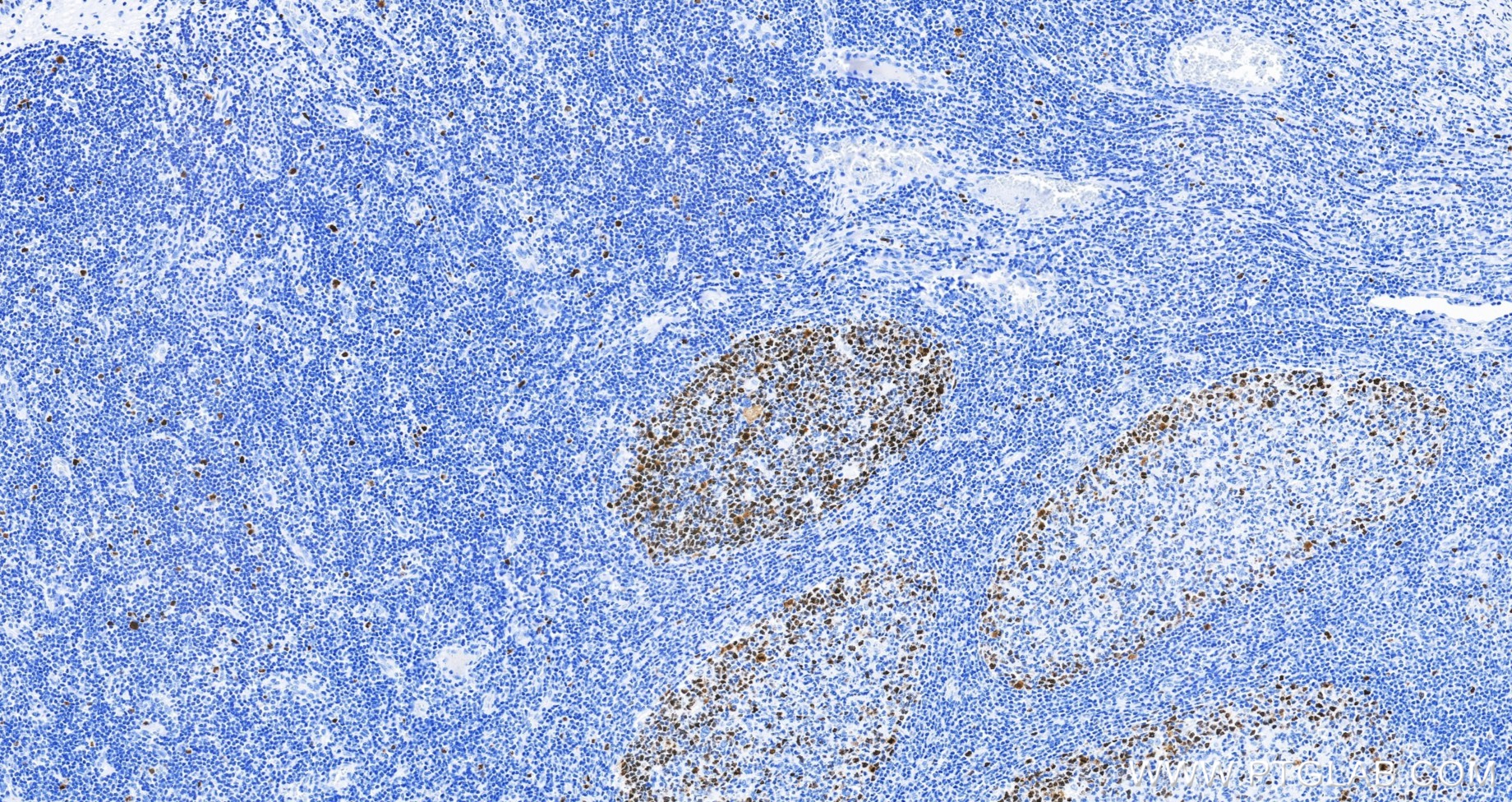 IHC staining of human tonsillitis using 82738-10-RR IHC staining of human tonsillitis using 82738-10-RR